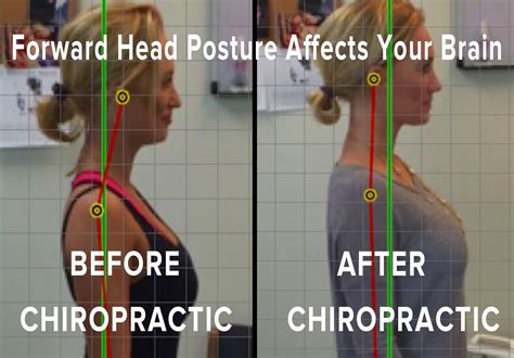 Forward Head Posture Effects Your Brain - TRUCHIRO