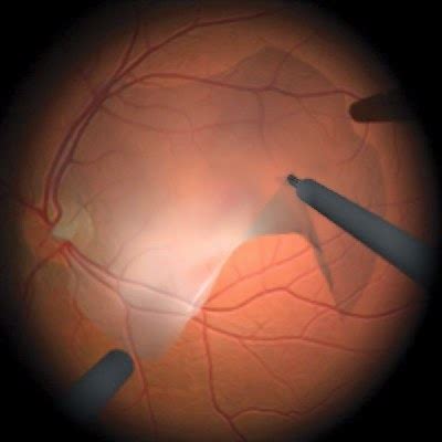 Diagnose My Retinal Photo: Epiretinal Membrane - Eyedolatry