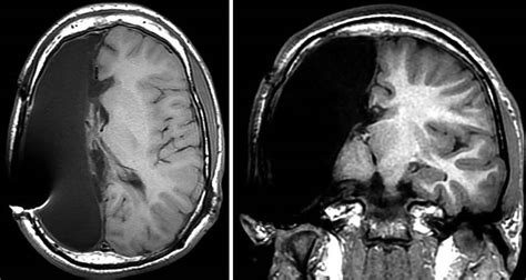 Hemispherectomy indications, prognosis, risks, side effects & complications