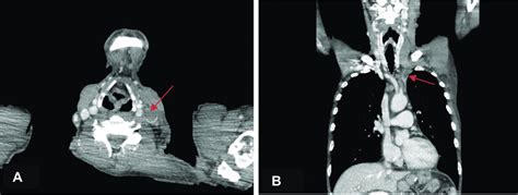 A, B Thrombosis in the left internal jugular vein and Thrombosis in the... | Download Scientific ...