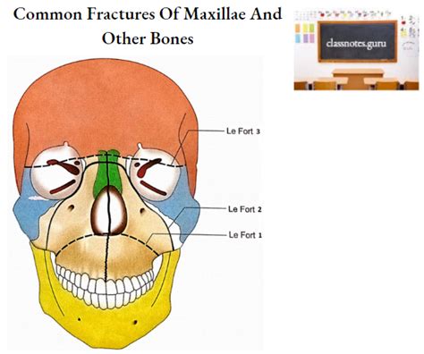 Maxilla Osteology Anatomy Notes - Class Notes