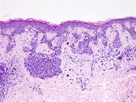 Dysplastic Nevus Histology