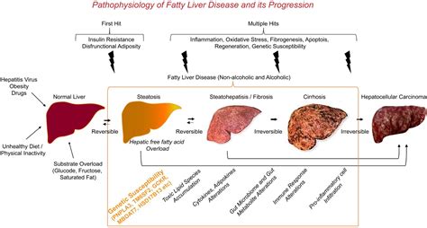 Non Alcoholic Fatty Liver Disease Nafld Progression G - vrogue.co