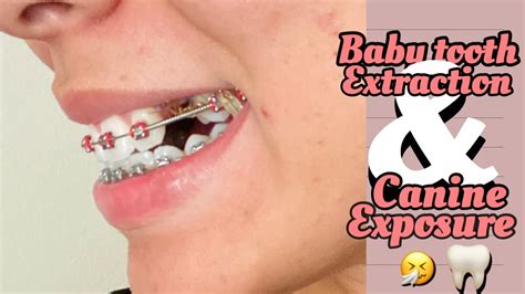 BABY TOOTH EXTRACTION & CANINE EXPOSURE ~ - YouTube