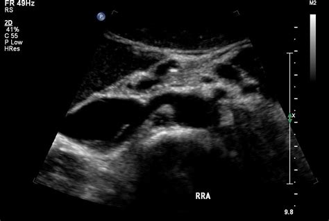 renal arteries – ULTRASOUNDPAEDIA