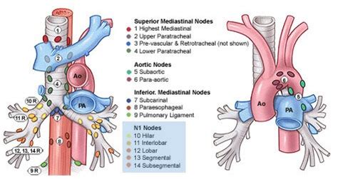 TNM and Staging of Lung Cancer Simplified | Epomedicine