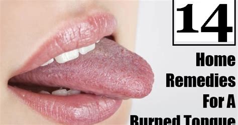 14 Home Remedies for Burning Tongue - Natural Remedies And Treatment