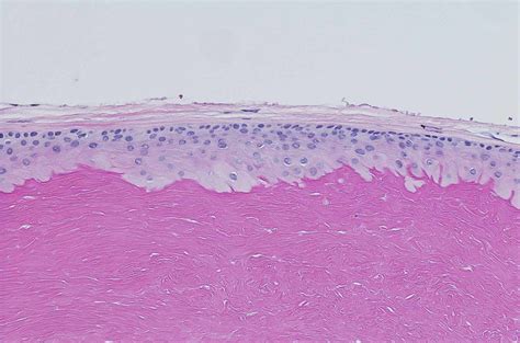 Pilar Cyst Histology