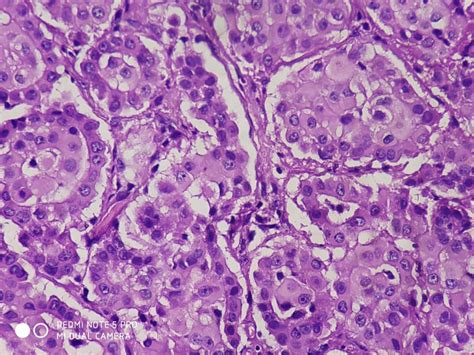 EPITHELIAL MALIGNANT MESOTHELIOMA – Histopathology.guru