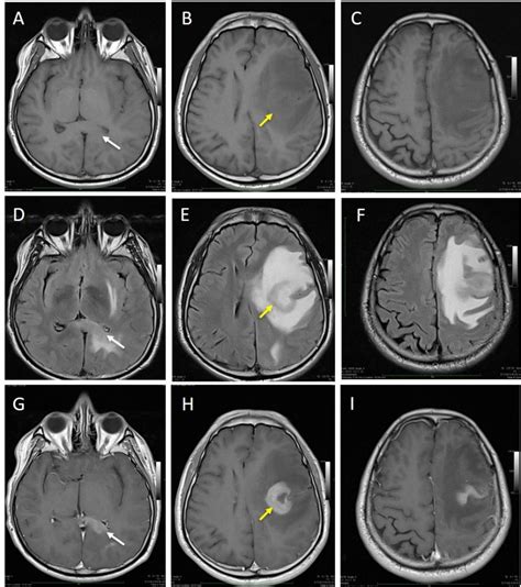 Primary CNS lymphoma with recurrence – Radiology Cases