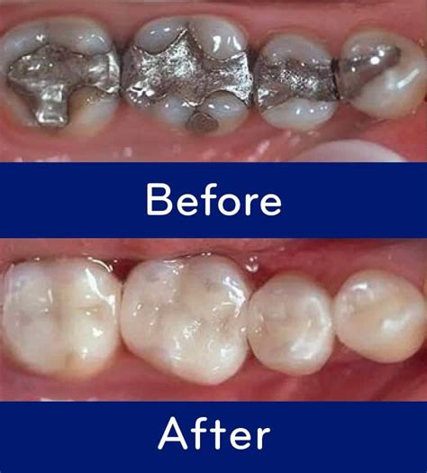 Ozone treatment for Cavities in Rockville