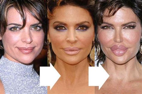 Lisa-Rinna-Lip-Injection-Plastic-Surgery-Disaster-Before-and-After Bad ...