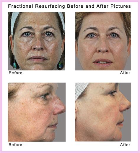 Erbium Fractional Laser Skin Resurfacing - BEAUTYWORKS