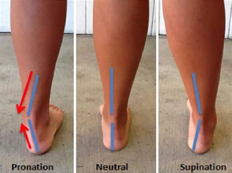 Overpronation, overpronation causes and how to fix overpronation