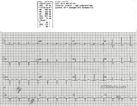 Left axis deviation | ECG Guru - Instructor Resources