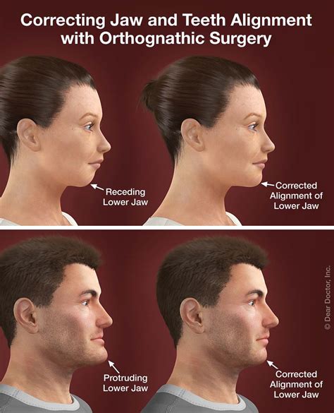 Corrective (Jaw) Surgery | Mary E. Burns D.M.D. | New Hope Pennsylvania