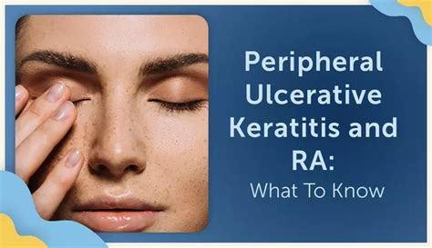 Peripheral Ulcerative Keratitis and RA: What To Know | myRAteam