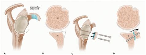 Latarjet Procedure for Instability with Bone Loss | Musculoskeletal Key