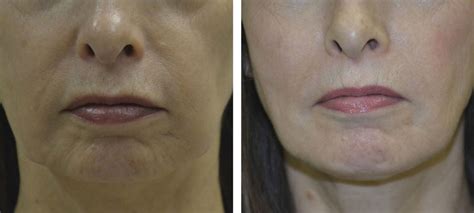 Jowls Treatment | Before & After | Kingsway Dermatology