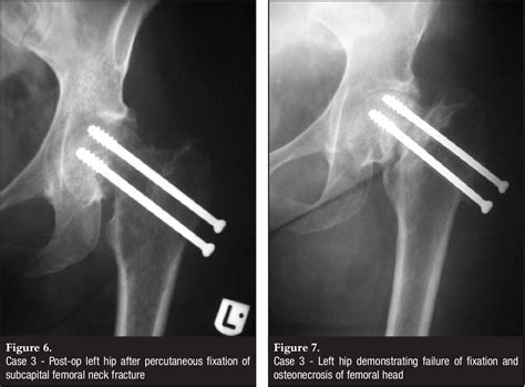 Normal hip xray femoral neck fracture xray - holfmye