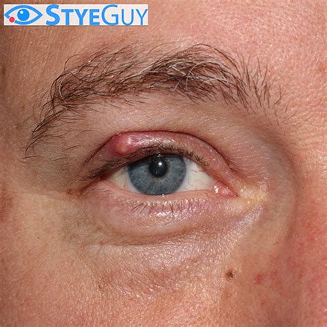 Upper Eyelid Stye | StyeGuy