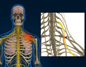 Thoracic Spine Nerve Pain