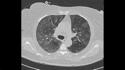 Crazy paving pattern on CT in COVID-19 pneumonia - YouTube