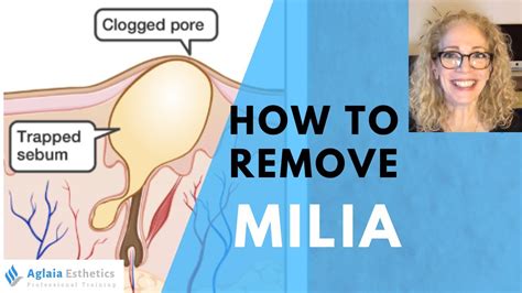 HOW TO REMOVE A MILIA STEP BY STEP | NATURALLY - YouTube