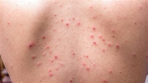 How to Prevent and Treat 8 Common Skin Conditions | Everyday Health