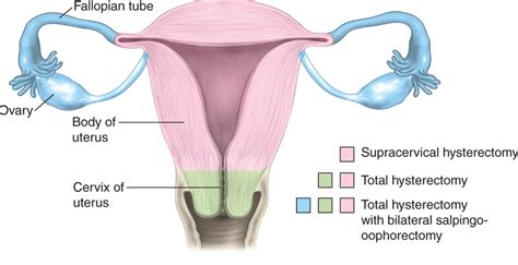 Hysterectomy - Philippe de Rosnay