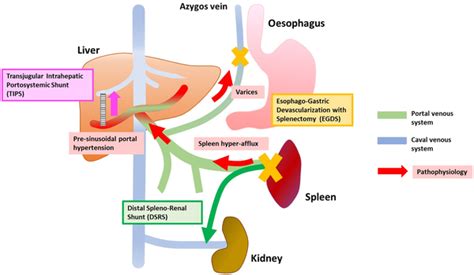 Splenorenal Shunt Embolization