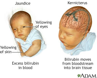 My Baby Needs Surgery and Has a High Billiruben - Patterson Samostow