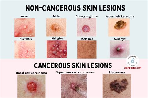 Types Of Skin Lesions Diagnosis Causes Symptoms And Treatment | Porn Sex Picture