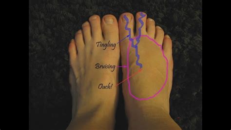 Middle top of foot pain when walking - opmbc