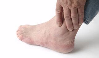 What Is Gout - Causes, Symptoms and Treatment | Live Science