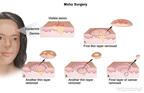 Mohs Surgery | Knight Cancer Institute | OHSU