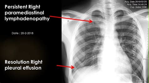 CASE 639 TB pleural effusion ,mediastinal lymphadenopathy - YouTube