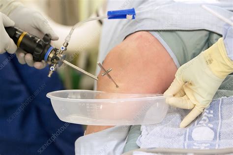 Knee arthroscopy - Stock Image - C016/9882 - Science Photo Library