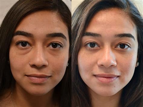 Lower Blepharoplasty Before and After Photos | Fresh Face + Eye