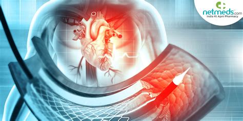 Catheter Angiography: What Is It, How It Is Done, And What To Expect?