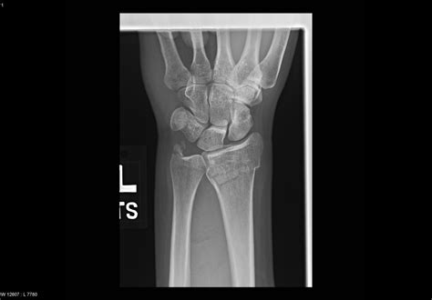 Fracture of distal ulna - Xray - radRounds Radiology Network