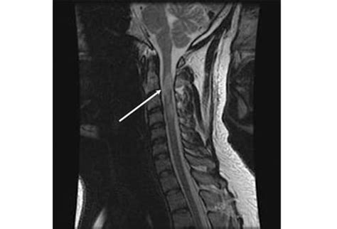 Multiple Sclerosis Research: Research: Spinal Lesions at First ...