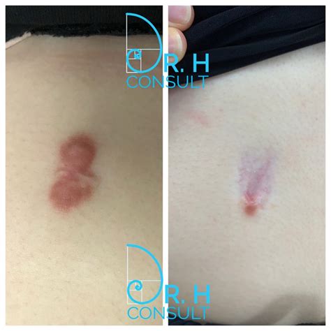 Keloid Scar Treatment / Removal London & Surrey | Dr H Consult