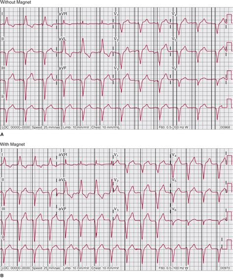 Conduction Disorders & Cardiac Pacing | Thoracic Key