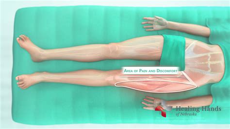 Dr. Aguila Explains Meralgia Paresthetica - Healing Hands of Nebraska