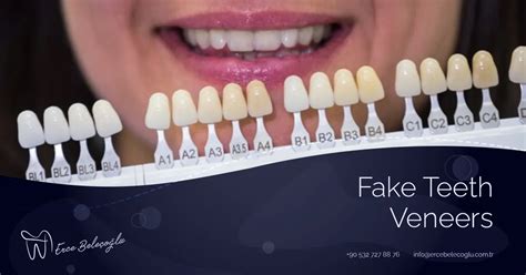 Fake Teeth Veneers - Are Veneers Fake Teeth