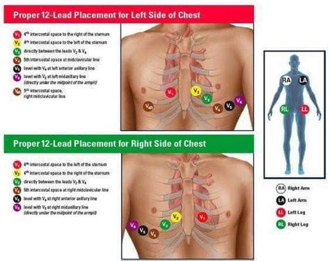 12 lead placement | Ekg placement, Nursing student tips, Ekg interpretation