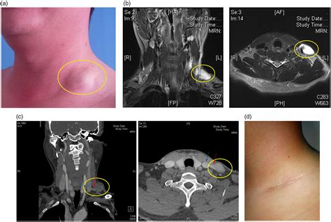 Diagnosis and treatment of intermuscular venous malformations: A retrospective study in one ...