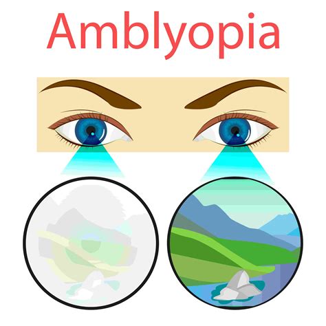 Amblyopia (Lazy Eye) Treatment in Chicago, IL | Kraff Eye Institute