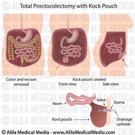 Alila Medical Media | Total Proctocolectomy with Brooke Ileostomy ...